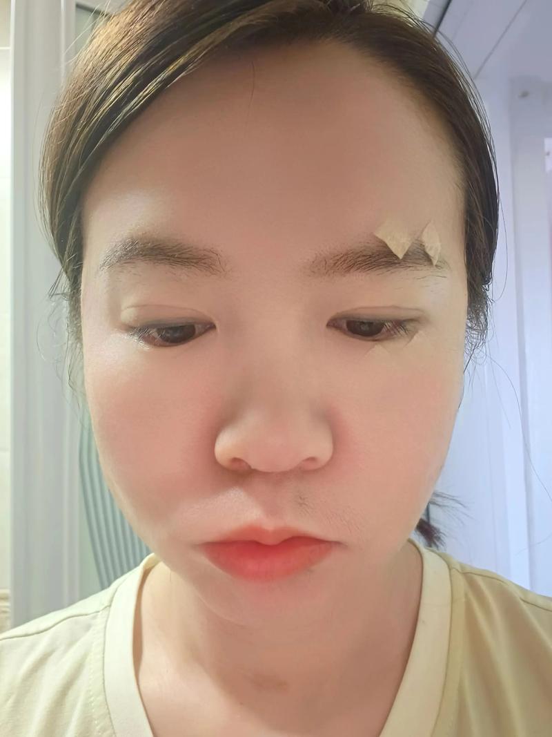 面瘫针灸1个月还没好