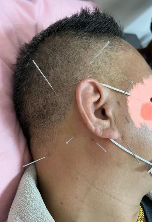 针灸治疗肠易激综合征