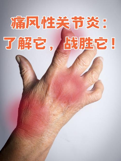 臭氧治疗痛风性关节炎