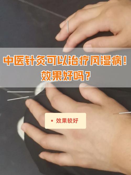 山东省中医针灸怎么样