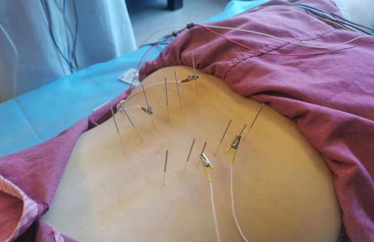 山东省中医针灸怎么样