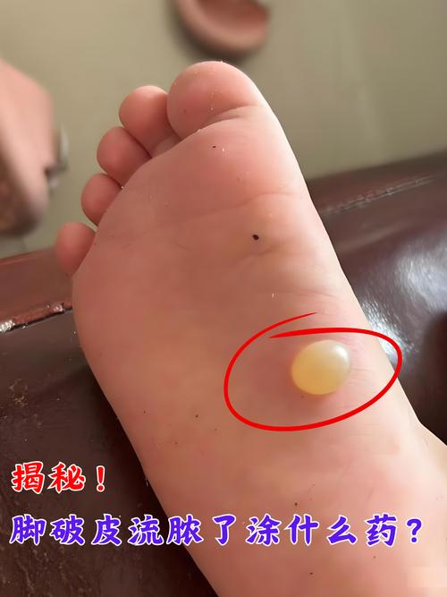 为啥针灸脚肿会流黄水