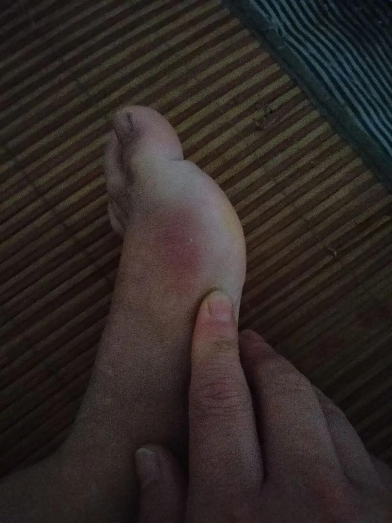 为啥针灸脚肿会流黄水