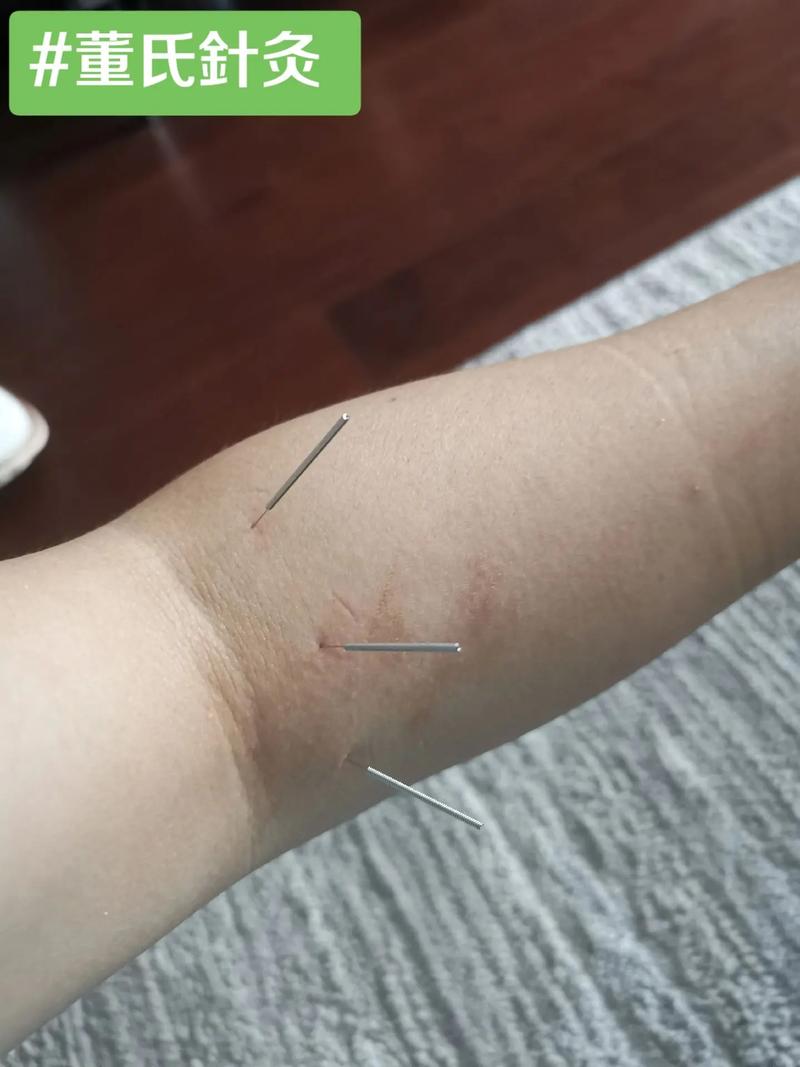 董氏针灸治皮肤瘙痒症