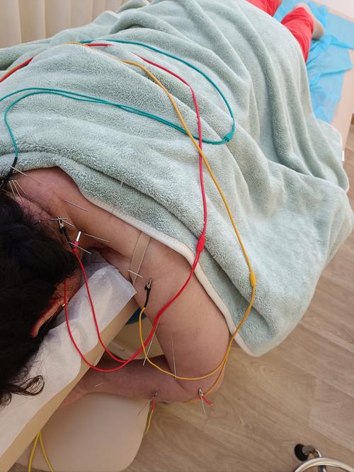 交感神经型颈椎病针灸