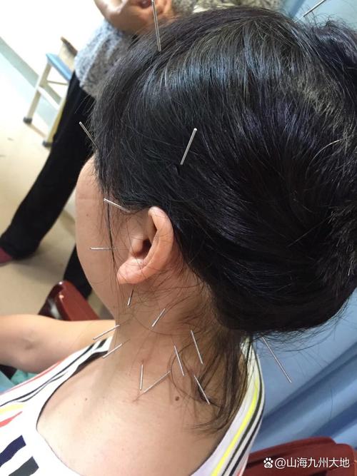 颈椎病针灸后头晕眼花