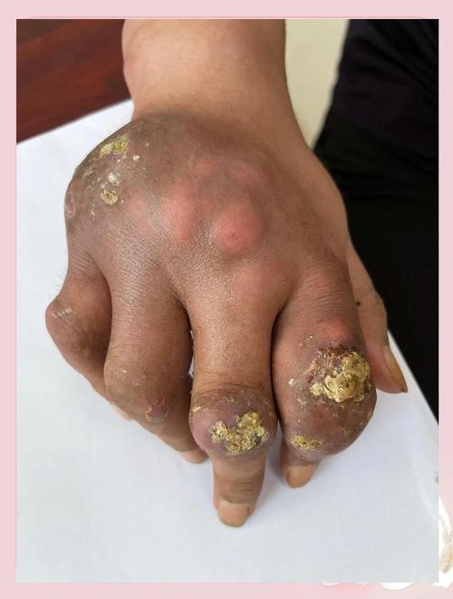 痛风石初期摸起来硬么