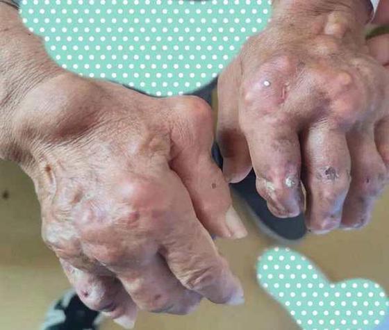 痛风石初期摸起来硬么