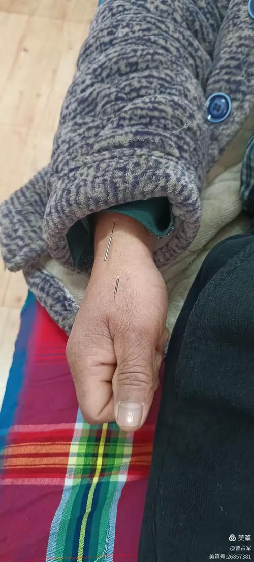 针灸治疗顽固性皮肤病