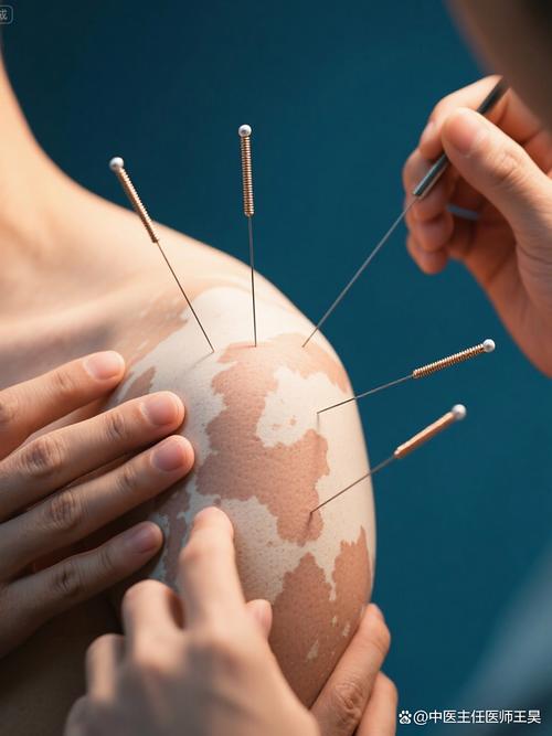 针灸治疗顽固性皮肤病