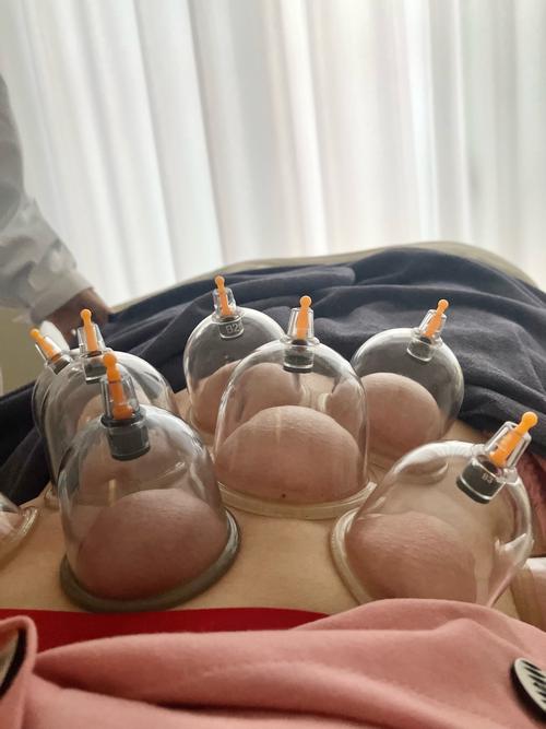 针灸拔罐减肥 中医院