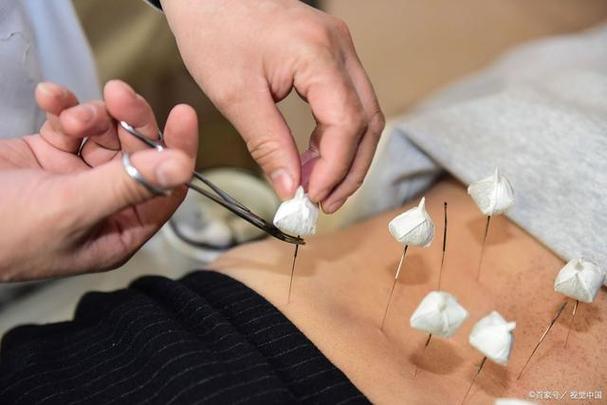 杭州省中医院针灸减肥