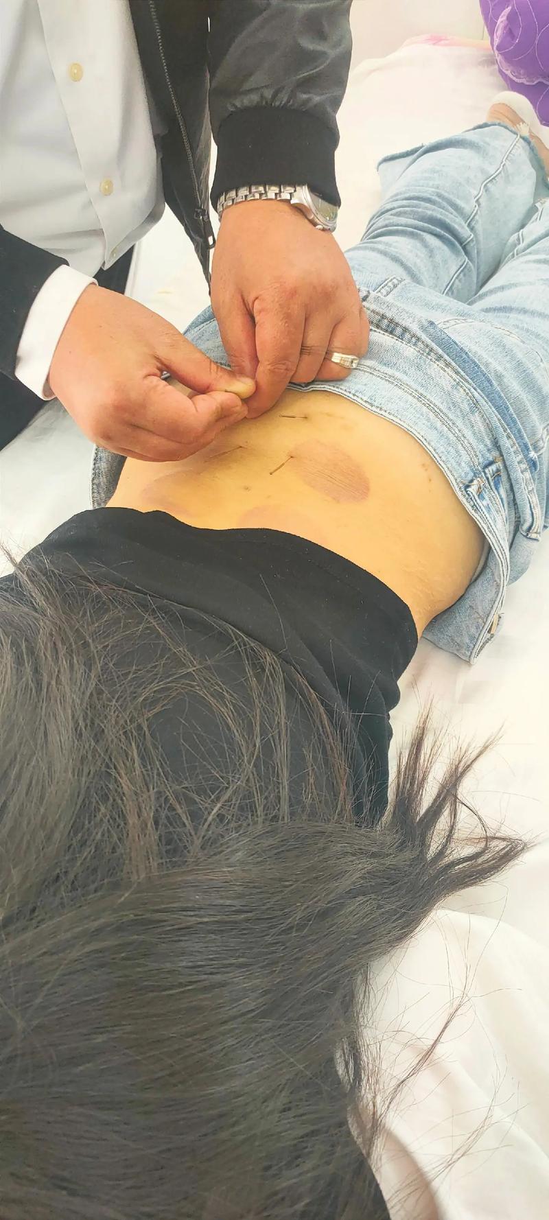 腰扭伤针灸后腰更疼了