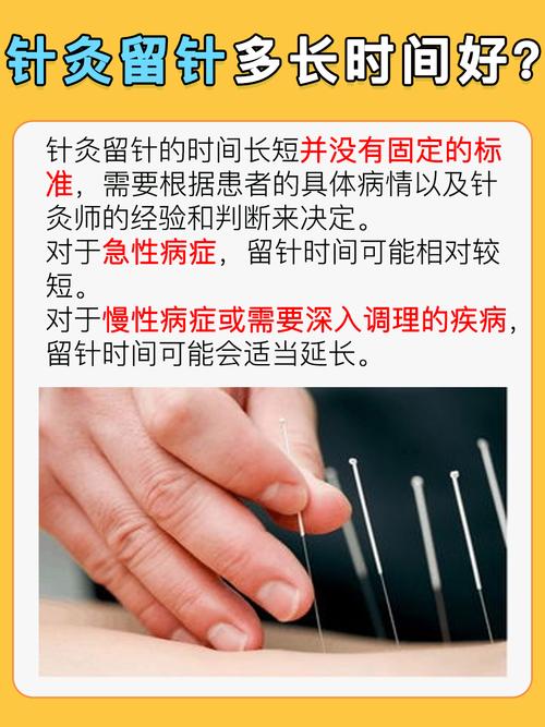 针灸每次需要多长时间
