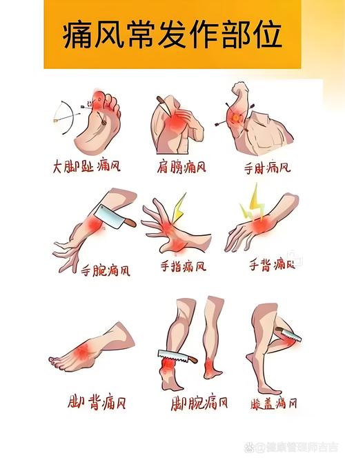 痛风发作为什么从膝盖