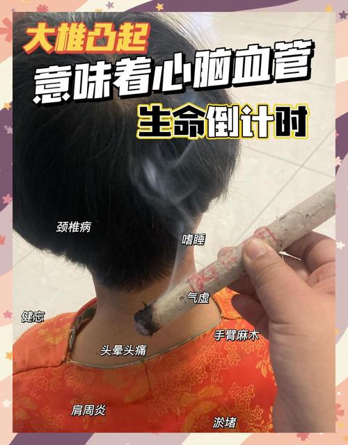 颈椎富贵包针灸拨罐图