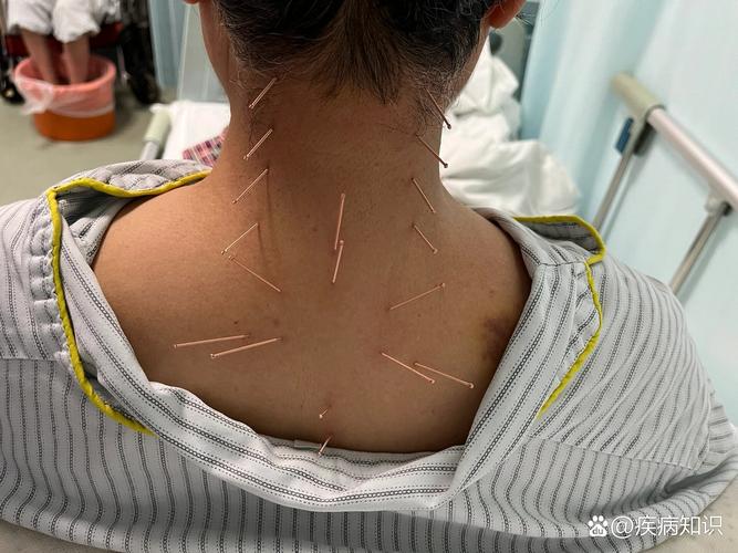 颈椎富贵包针灸拨罐图