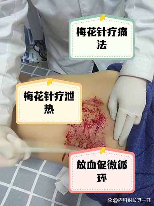 梅核气可以针灸治疗吗