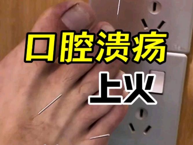 针灸可以治口腔溃疡吗