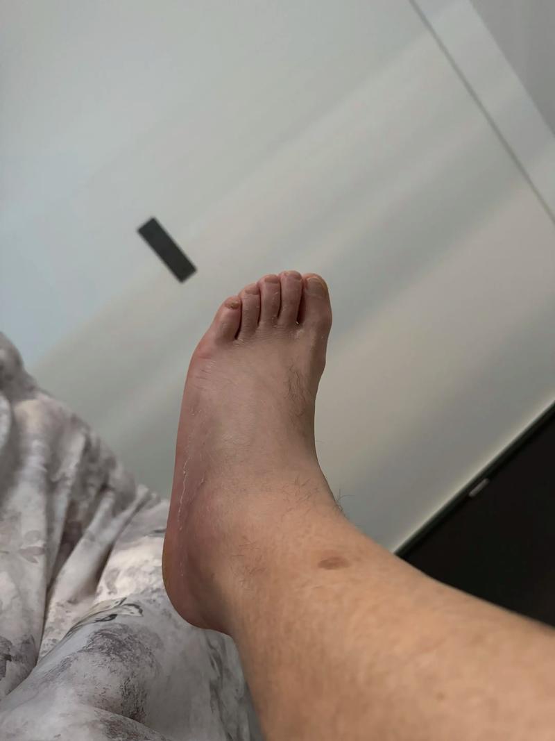 痛风会不会引起脚背肿