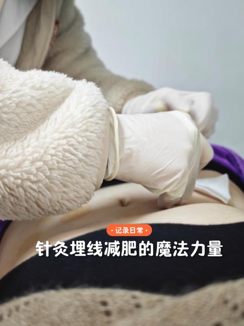 针灸埋线后可以运动吗