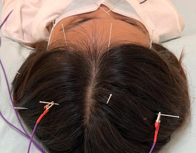 针灸治疗偏头疼有效吗