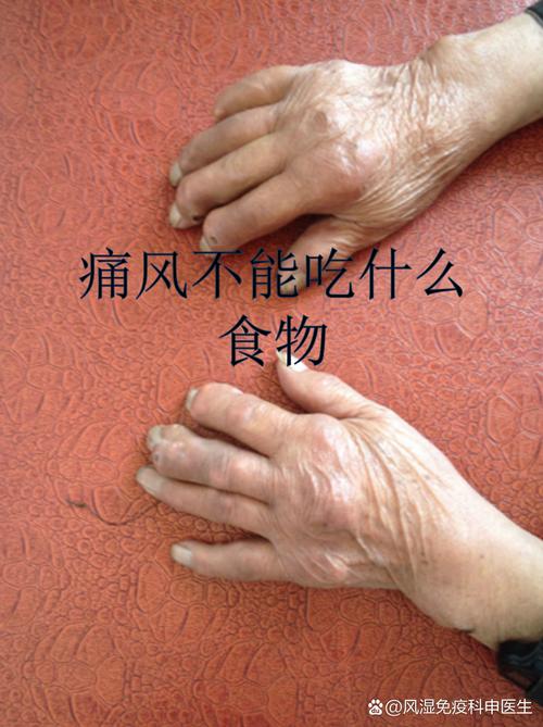 痛风病人能不能吃羊肉