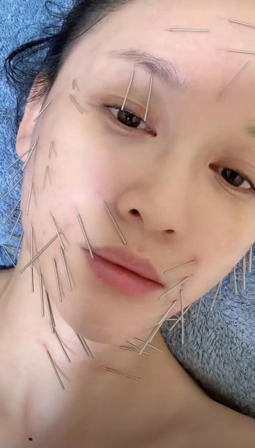 针灸瘦脸有什么副作用