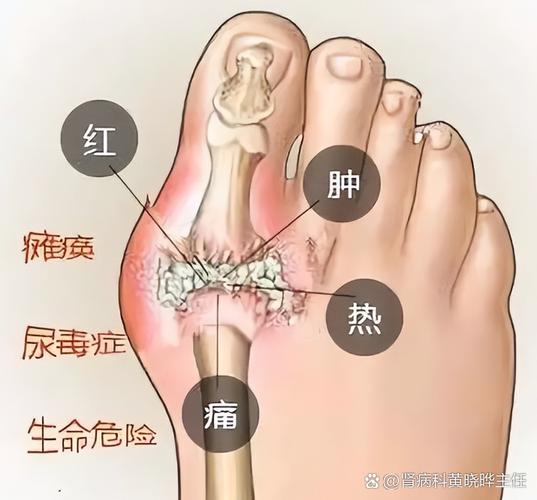 大脚趾有点痛是痛风吗