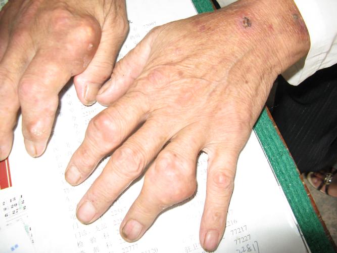 慢性痛风性关节炎症状