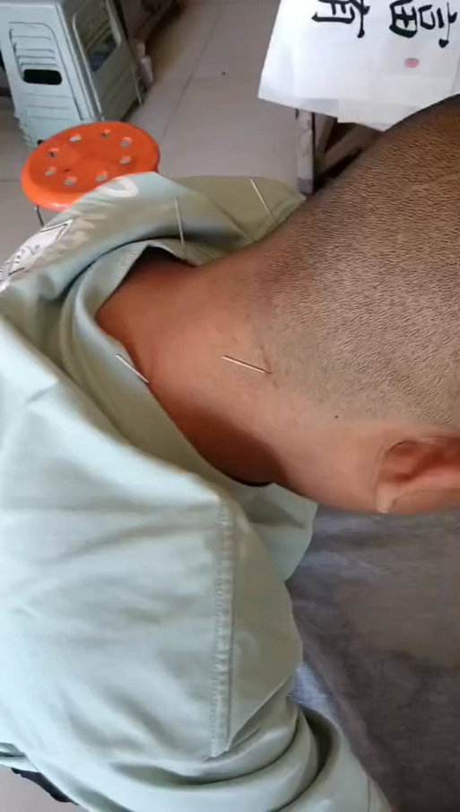 临沂比较好的针灸中医