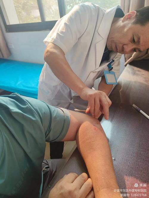 针灸治疗肱骨外上髁炎