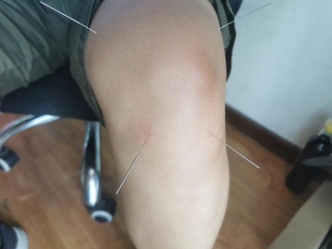 针灸治疗膝盖骨质增生