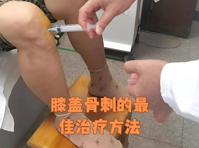 针灸治疗膝盖骨质增生