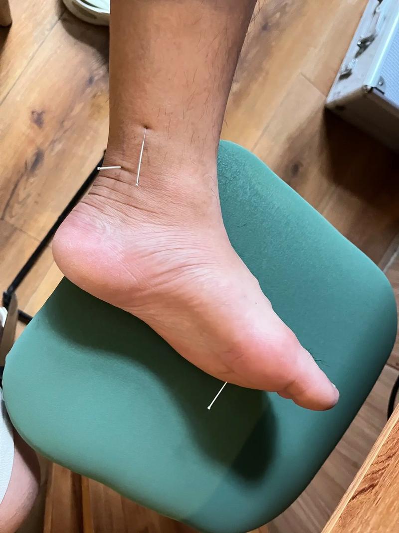 尿酸高脚肿可以针灸吗