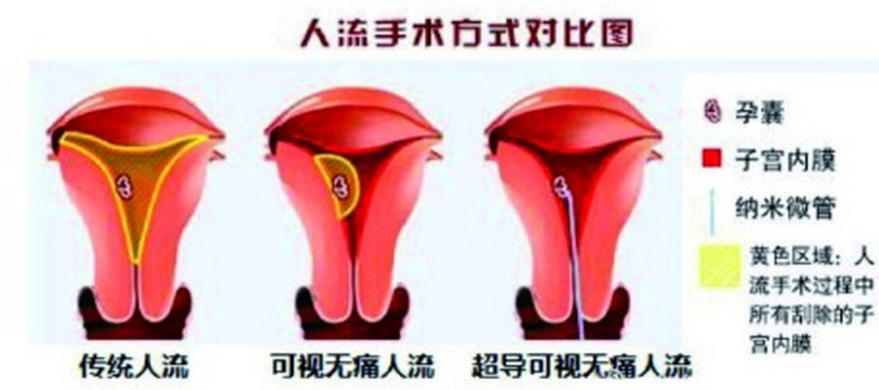 最安全的无痛人流是哪家