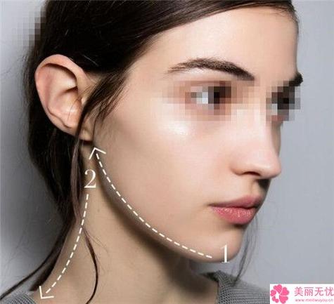 注射botox瘦脸安全