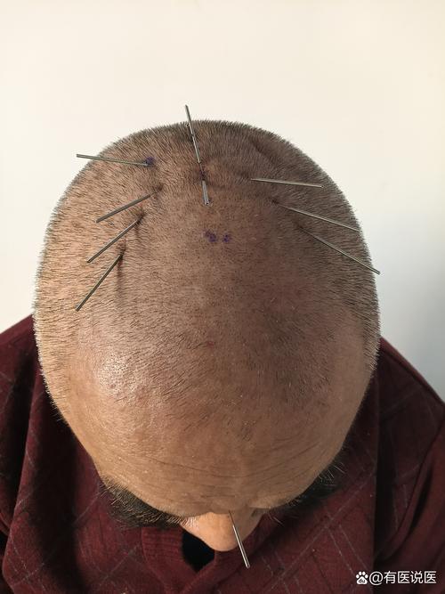 廊坊哪扎针灸治面瘫好