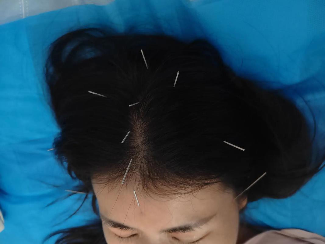 廊坊哪扎针灸治面瘫好