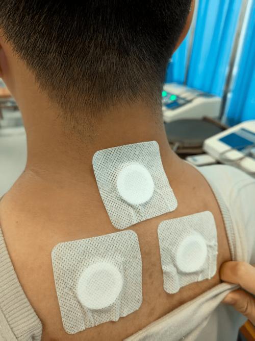 贴针灸效果到底怎么样