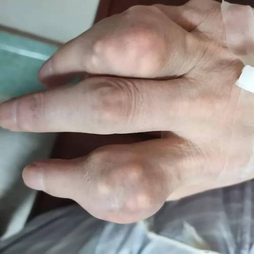 痛风十几天不好还肿痛