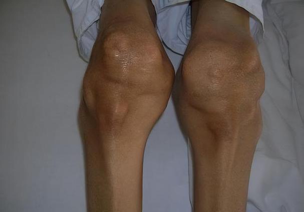 膝关节痛风症状有哪些