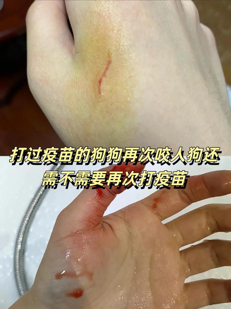 狂犬抗体阳性 安全了吗