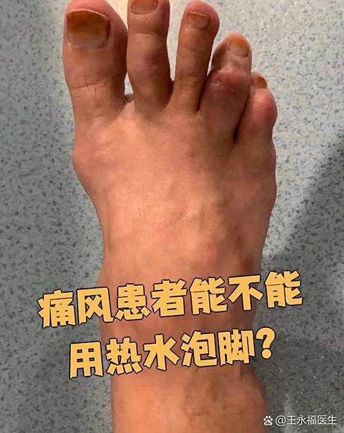 痛风发作时可以用热水