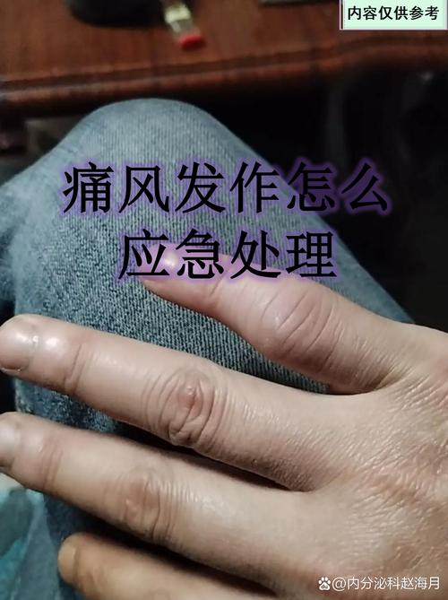 痛风发作时可以用热水