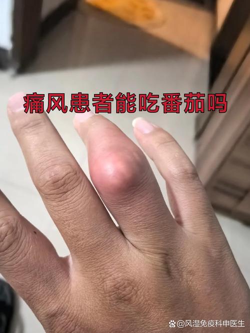 痛风能不能吃小西红柿