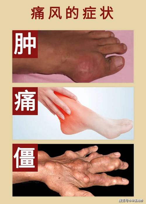 为什么痛风会越来越痛