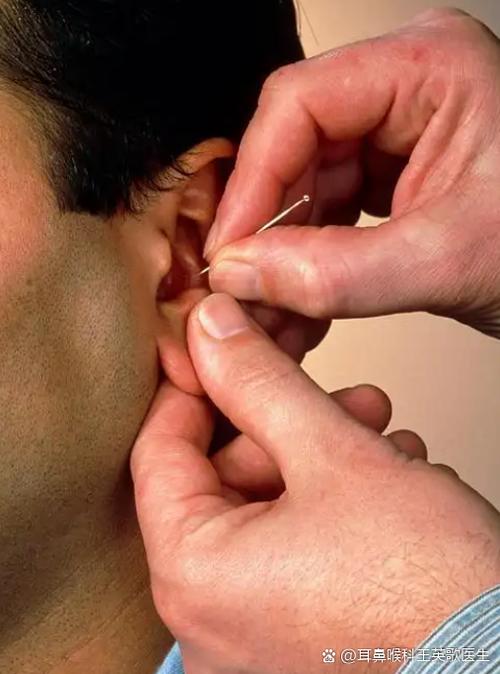 耳鸣针灸需要多长时间