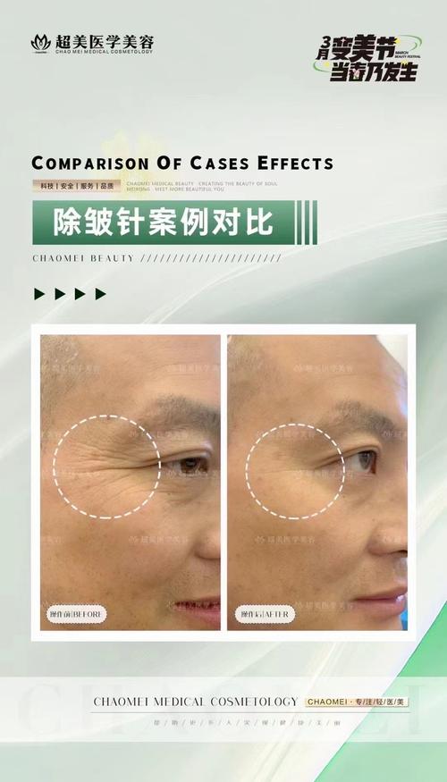 botox祛鱼尾纹安全