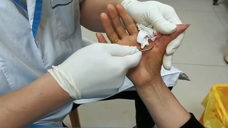 针灸治疗大拇指腱鞘炎